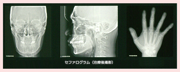セファログラム（頭部X線規格写真）